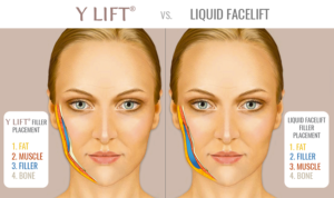 Y-LIFT-vs-Liquid-Facelift-Filler-Placement-1